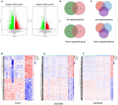 Identification of Key Functional Gene Signatures Indicative of Dedifferentiation in Papillary Thyroid Cancer